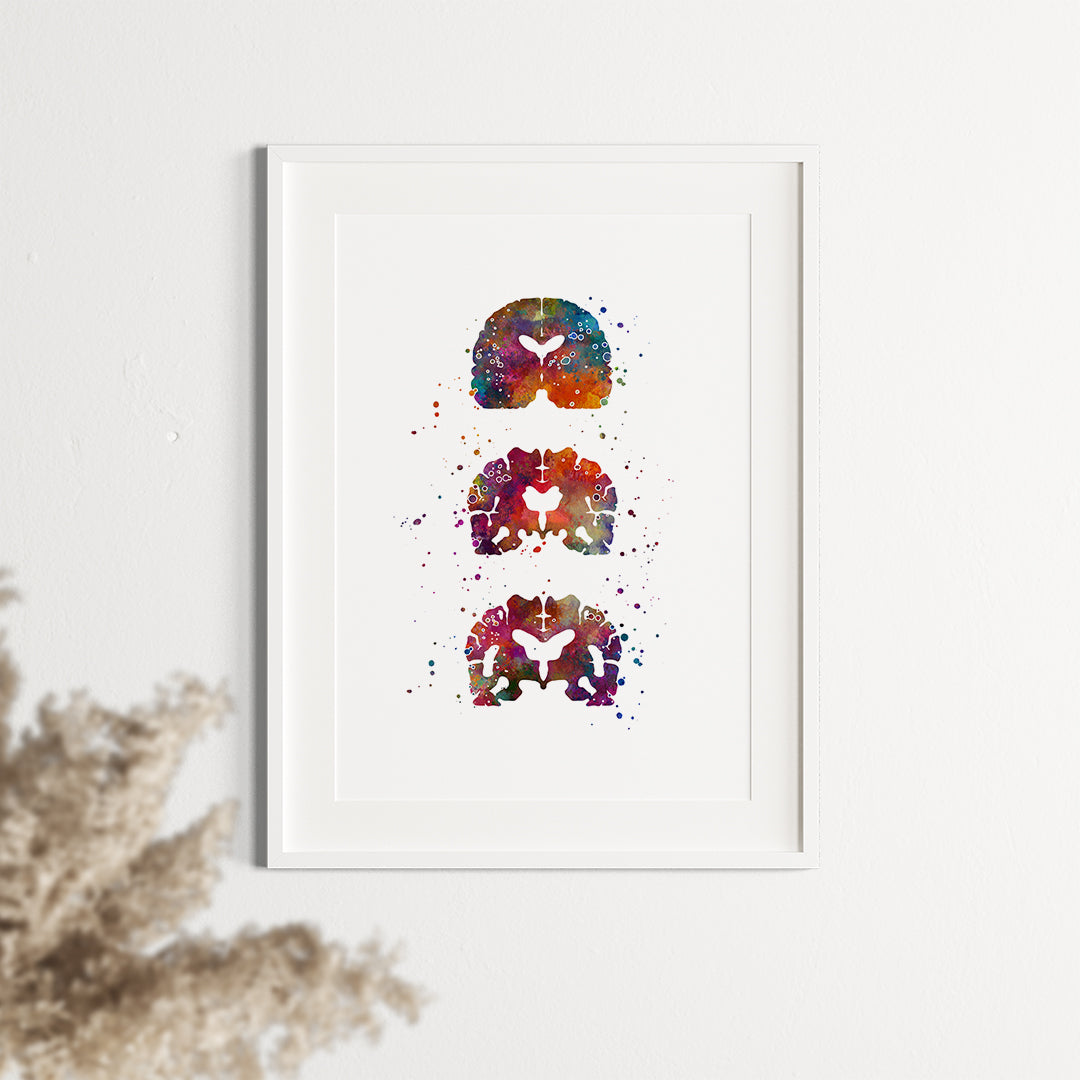 Alzheimers Brain Watercolor Art Print - Neurology Decor